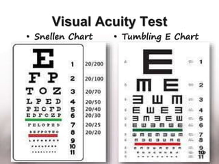 Visual Acuity Test
• Snellen Chart • Tumbling E Chart
30
 