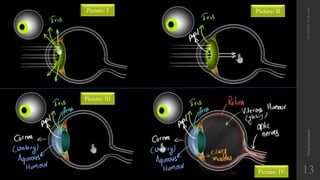 12/19/2022
10:56
AM
Visual
Impairment
13
Picture: I
Picture: IV
Picture: III
Picture: II
 