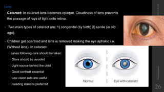Lens:
• Cataract: In cataract lens becomes opaque. Cloudiness of lens prevents
the passage of rays of light onto retina.
• Two main types of cataract are: 1) congenital (by birth) 2) senile (in old
age).
• Children get operated and lens is removed making the eye aphakic i.e.
(Without lens). In cataract
 cases following care should be taken:
 Glare should be avoided
 Light source behind the child
 Good contrast essential
 Low vision aids are useful
 Reading stand is preferred
12/19/2022
10:56
AM
Visual
Impairment
26
 