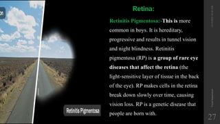 12/19/2022
10:56
AM
Visual
Impairment
27
Retina:
Retinitis Pigmentosa:-This is more
common in boys. It is hereditary,
progressive and results in tunnel vision
and night blindness. Retinitis
pigmentosa (RP) is a group of rare eye
diseases that affect the retina (the
light-sensitive layer of tissue in the back
of the eye). RP makes cells in the retina
break down slowly over time, causing
vision loss. RP is a genetic disease that
people are born with.
 