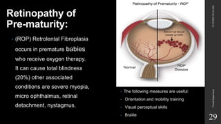 Retinopathy of
Pre-maturity:
• (ROP) Retrolental Fibroplasia
occurs in premature babies
who receive oxygen therapy.
It can cause total blindness
(20%) other associated
conditions are severe myopia,
micro ophthalmus, retinal
detachment, nystagmus.
• The following measures are useful:
• Orientation and mobility training
• Visual perceptual skills
• Braille
12/19/2022
10:56
AM
Visual
Impairment
29
 