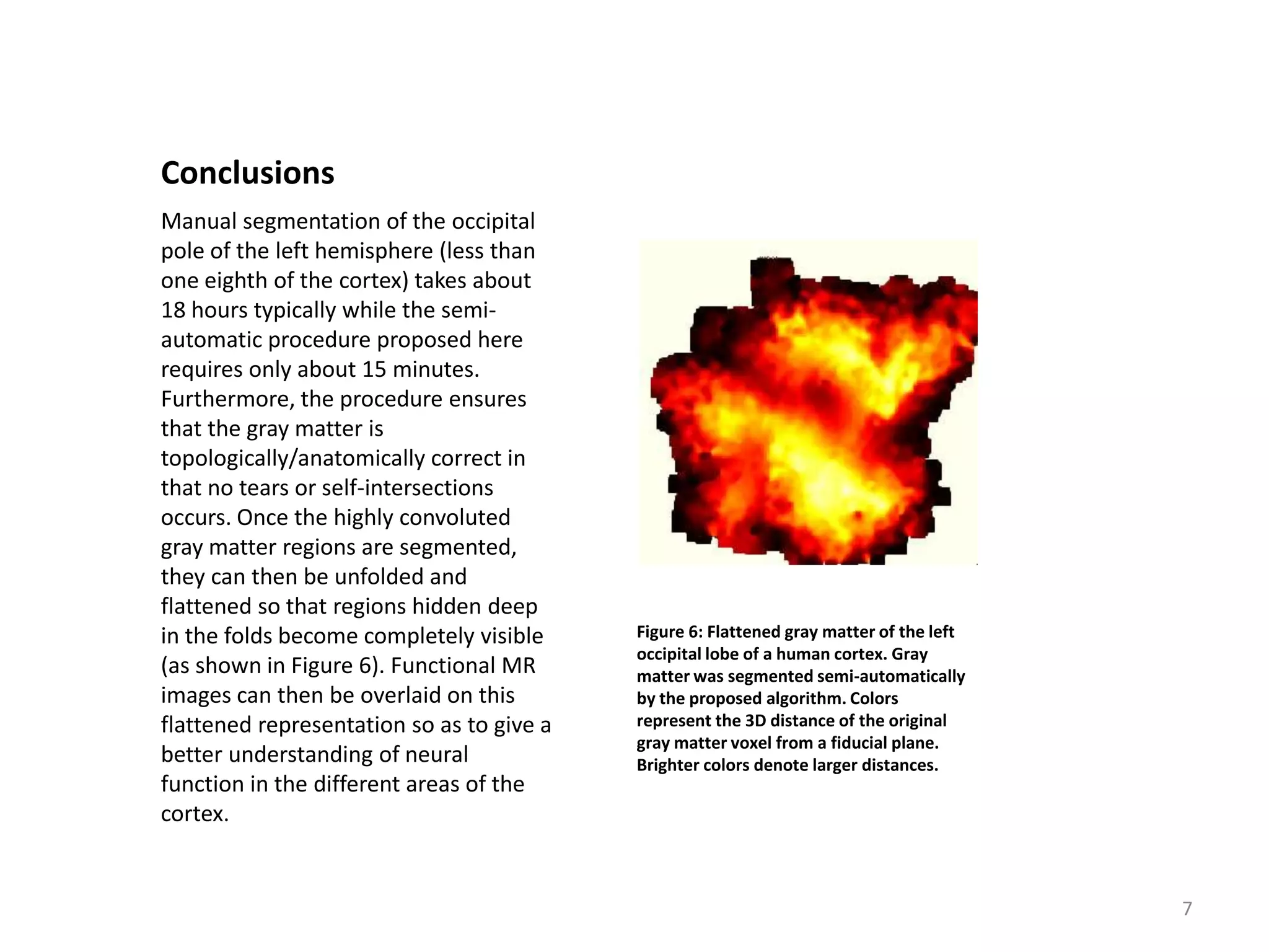 Conclusions
Manual segmentation of the occipital
pole of the left hemisphere (less than
one eighth of the cortex) takes about
18 hours typically while the semi-
automatic procedure proposed here
requires only about 15 minutes.
Furthermore, the procedure ensures
that the gray matter is
topologically/anatomically correct in
that no tears or self-intersections
occurs. Once the highly convoluted
gray matter regions are segmented,
they can then be unfolded and
flattened so that regions hidden deep
in the folds become completely visible     Figure 6: Flattened gray matter of the left
                                           occipital lobe of a human cortex. Gray
(as shown in Figure 6). Functional MR      matter was segmented semi-automatically
images can then be overlaid on this        by the proposed algorithm. Colors
flattened representation so as to give a   represent the 3D distance of the original
                                           gray matter voxel from a fiducial plane.
better understanding of neural             Brighter colors denote larger distances.
function in the different areas of the
cortex.


                                                                                         7
 