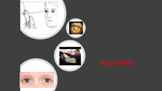Red reflex
 