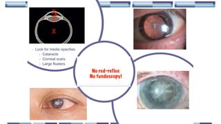 • Look for media opacities
• Cataracts
• Corneal scars
• Large floaters
 