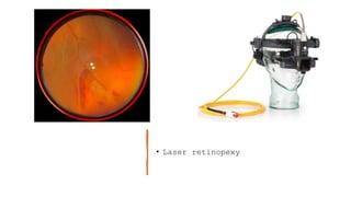• Laser retinopexy
 