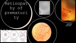 Retinopat
hy of
prematuri
ty
 