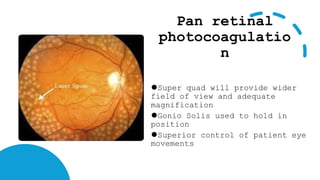Pan retinal
photocoagulatio
n
⚫Super quad will provide wider
field of view and adequate
magnification
⚫Gonio Solis used to hold in
position
⚫Superior control of patient eye
movements
 