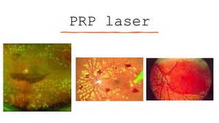 PRP laser
 