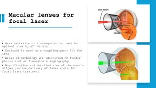Macular lenses for
focal laser
• Area centralis or transequator is used for
optimal viewing of macula
• Goniosol is used as a coupling agent for the
lens
• Areas of pathology are identified on fundus
photos and/ or fluorescein angiography
• Magnification and detailed view of the macula
allows precise delivery of laser spots for
focal laser treatment
 
