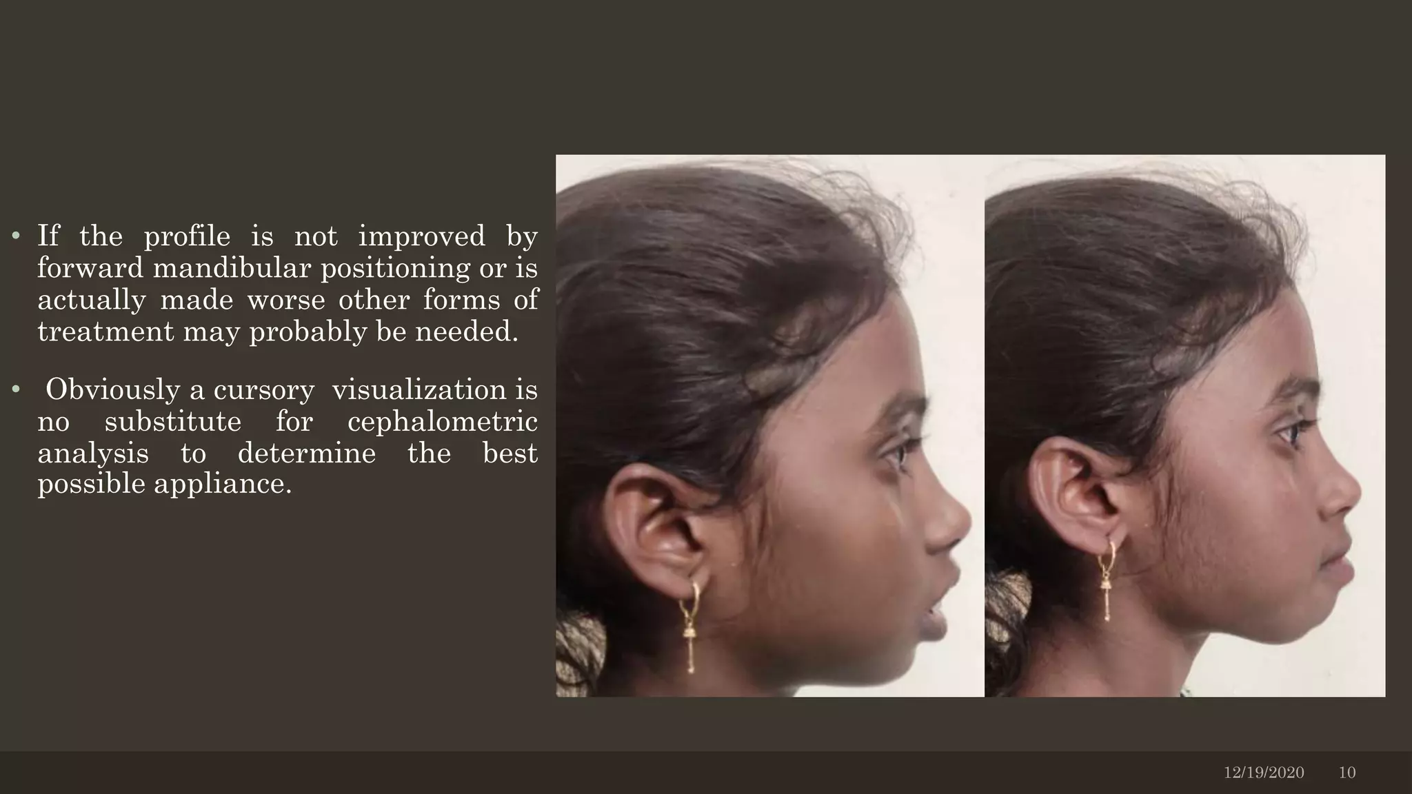 • If the profile is not improved by
forward mandibular positioning or is
actually made worse other forms of
treatment may probably be needed.
• Obviously a cursory visualization is
no substitute for cephalometric
analysis to determine the best
possible appliance.
12/19/2020 10
 