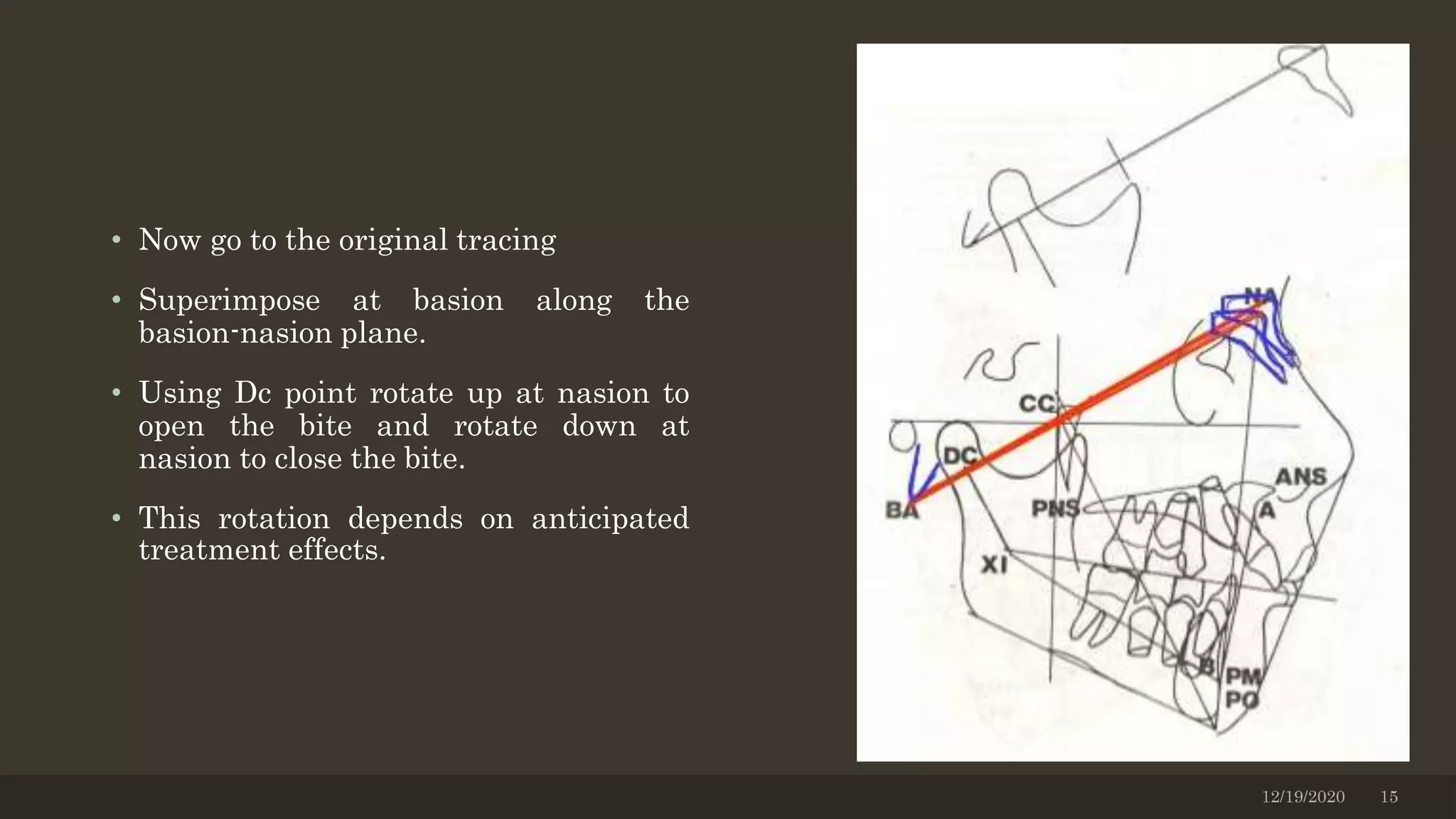 • Now go to the original tracing
• Superimpose at basion along the
basion-nasion plane.
• Using Dc point rotate up at nasion to
open the bite and rotate down at
nasion to close the bite.
• This rotation depends on anticipated
treatment effects.
12/19/2020 15
 