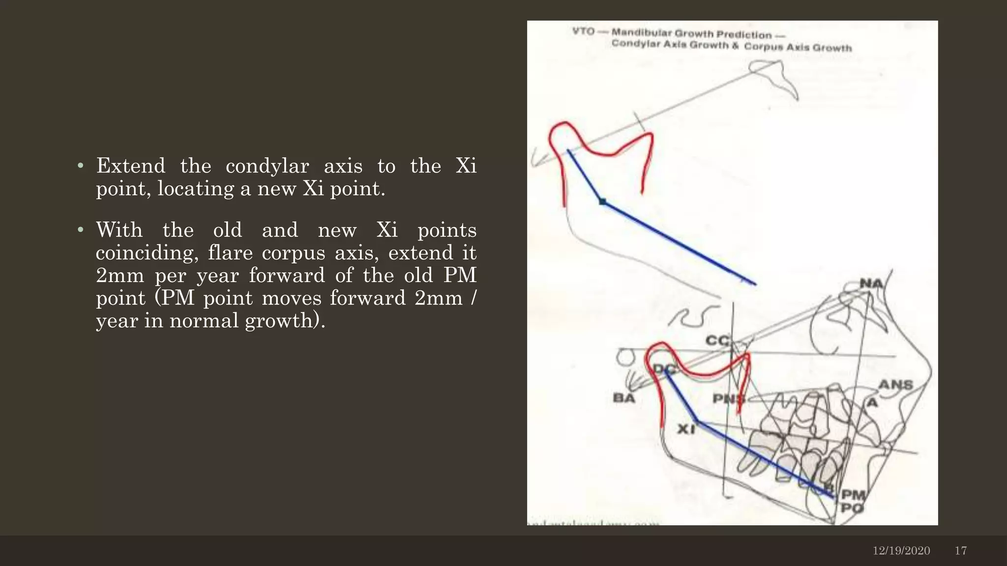• Extend the condylar axis to the Xi
point, locating a new Xi point.
• With the old and new Xi points
coinciding, flare corpus axis, extend it
2mm per year forward of the old PM
point (PM point moves forward 2mm /
year in normal growth).
12/19/2020 17
 