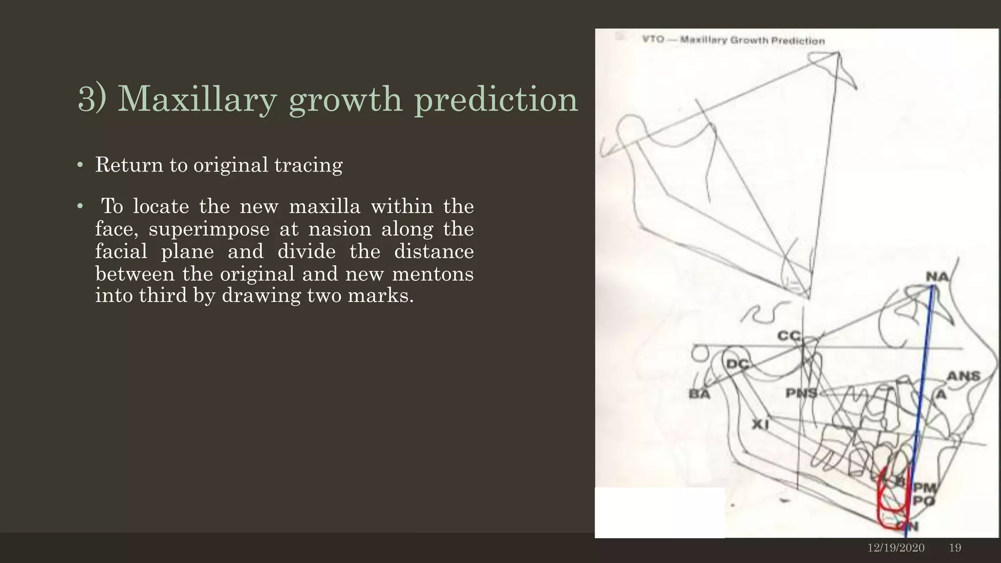 3) Maxillary growth prediction
• Return to original tracing
• To locate the new maxilla within the
face, superimpose at nasion along the
facial plane and divide the distance
between the original and new mentons
into third by drawing two marks.
12/19/2020 19
 
