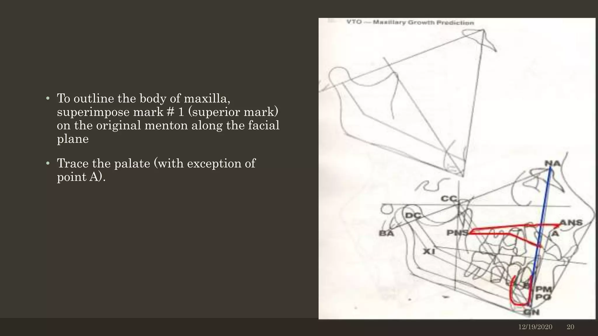 • To outline the body of maxilla,
superimpose mark # 1 (superior mark)
on the original menton along the facial
plane
• Trace the palate (with exception of
point A).
12/19/2020 20
 