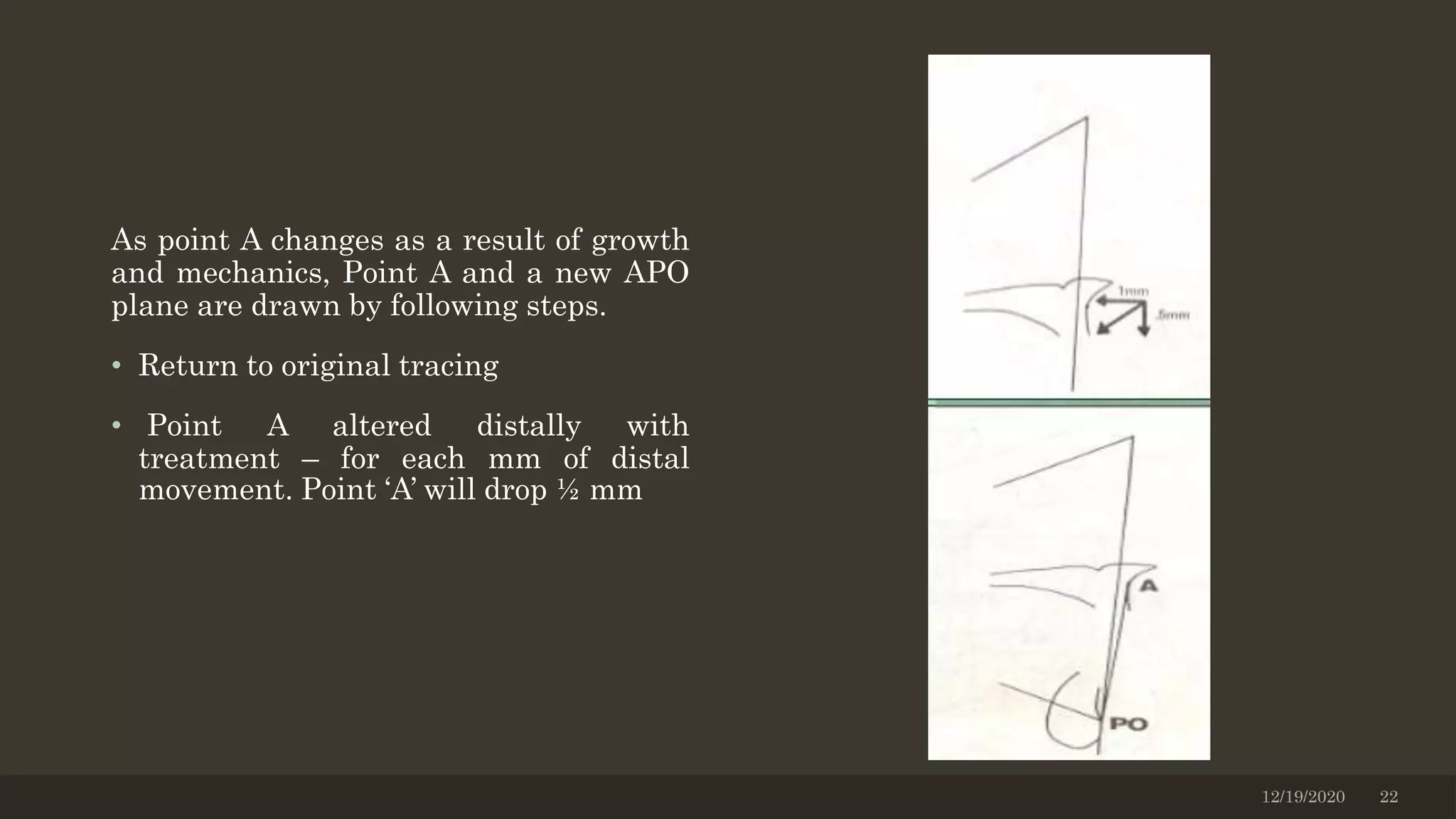 As point A changes as a result of growth
and mechanics, Point A and a new APO
plane are drawn by following steps.
• Return to original tracing
• Point A altered distally with
treatment – for each mm of distal
movement. Point ‘A’ will drop ½ mm
12/19/2020 22
 