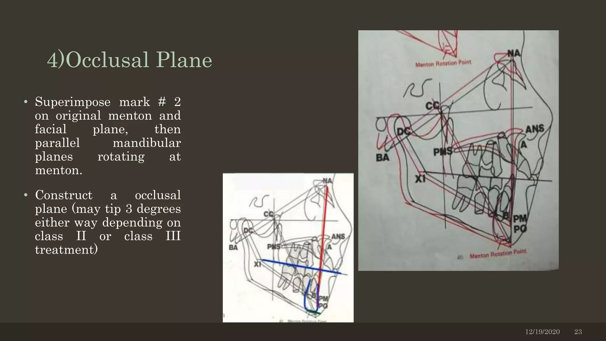 4)Occlusal Plane
• Superimpose mark # 2
on original menton and
facial plane, then
parallel mandibular
planes rotating at
menton.
• Construct a occlusal
plane (may tip 3 degrees
either way depending on
class II or class III
treatment)
12/19/2020 23
 