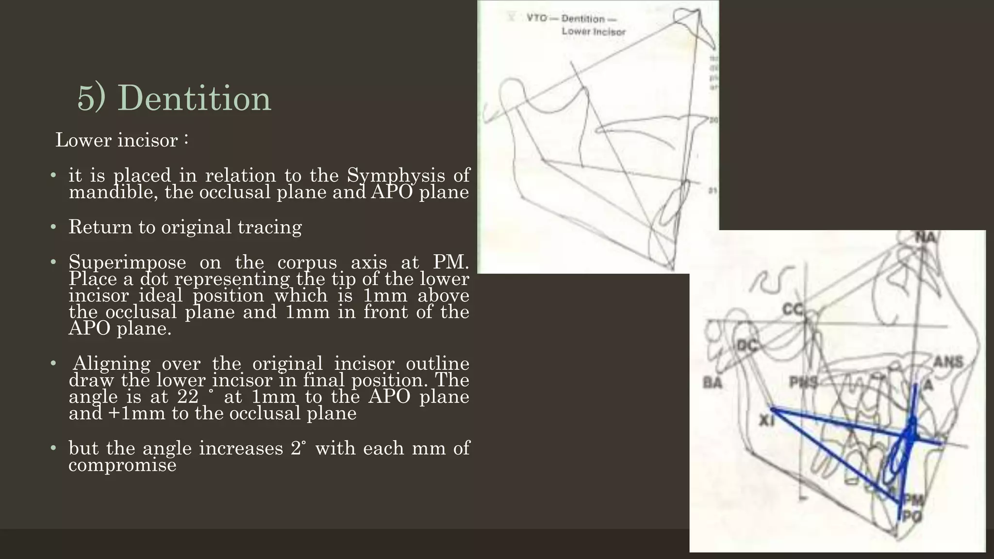 5) Dentition
Lower incisor :
• it is placed in relation to the Symphysis of
mandible, the occlusal plane and APO plane
• Return to original tracing
• Superimpose on the corpus axis at PM.
Place a dot representing the tip of the lower
incisor ideal position which is 1mm above
the occlusal plane and 1mm in front of the
APO plane.
• Aligning over the original incisor outline
draw the lower incisor in final position. The
angle is at 22 ̊ at 1mm to the APO plane
and +1mm to the occlusal plane
• but the angle increases 2 ̊ with each mm of
compromise
12/19/2020 24
 