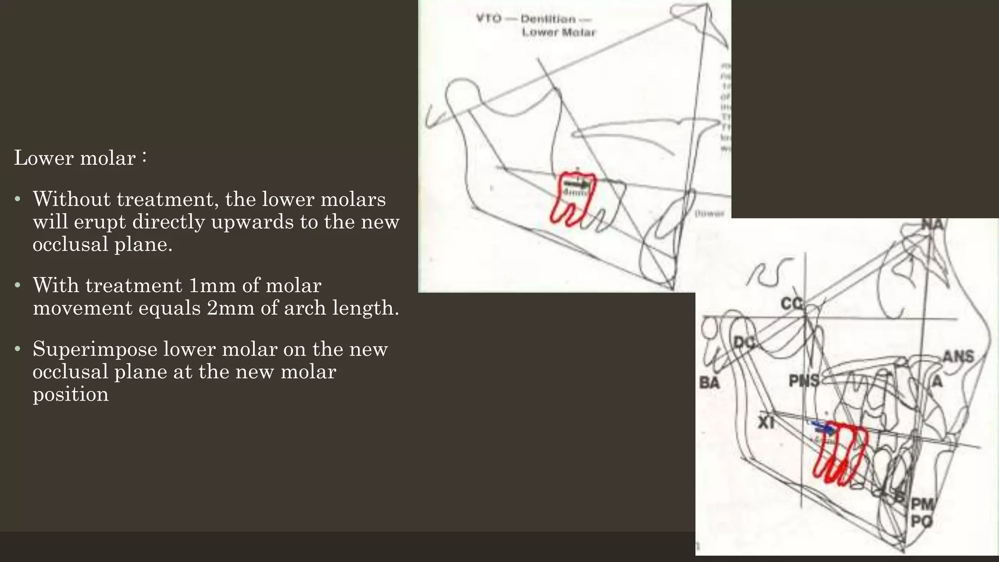 Lower molar :
• Without treatment, the lower molars
will erupt directly upwards to the new
occlusal plane.
• With treatment 1mm of molar
movement equals 2mm of arch length.
• Superimpose lower molar on the new
occlusal plane at the new molar
position
12/19/2020 25
 