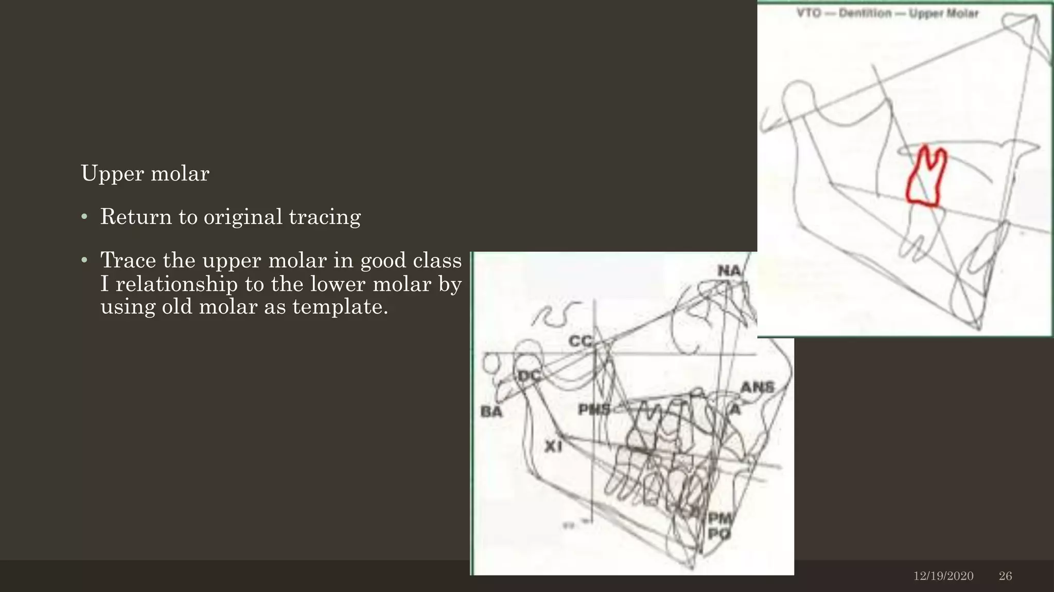 Upper molar
• Return to original tracing
• Trace the upper molar in good class
I relationship to the lower molar by
using old molar as template.
12/19/2020 26
 