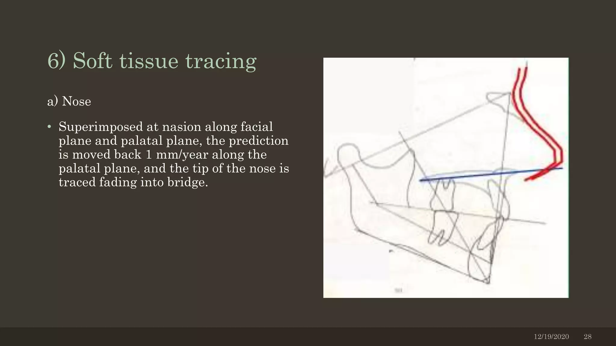 a) Nose
• Superimposed at nasion along facial
plane and palatal plane, the prediction
is moved back 1 mm/year along the
palatal plane, and the tip of the nose is
traced fading into bridge.
12/19/2020 28
6) Soft tissue tracing
 