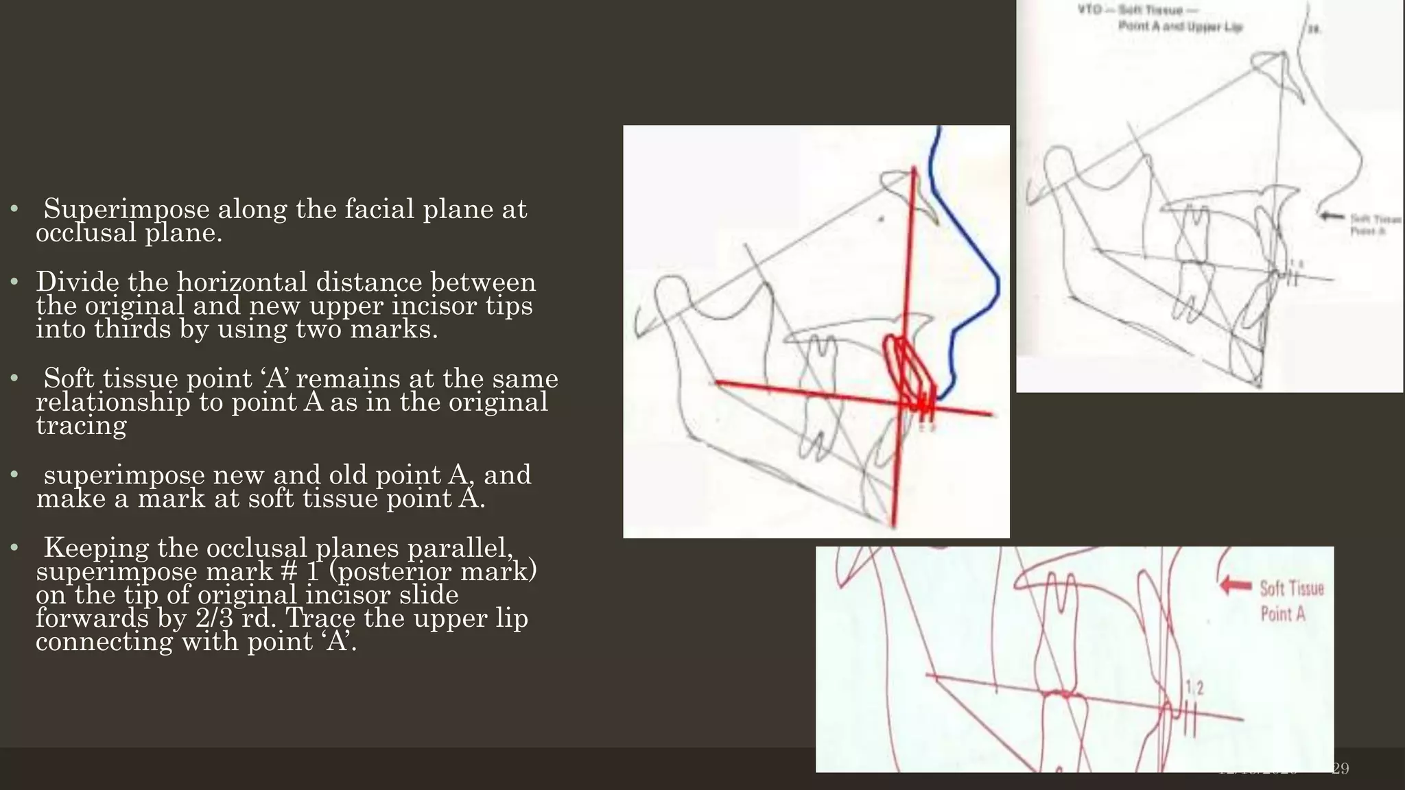 • Superimpose along the facial plane at
occlusal plane.
• Divide the horizontal distance between
the original and new upper incisor tips
into thirds by using two marks.
• Soft tissue point ‘A’ remains at the same
relationship to point A as in the original
tracing
• superimpose new and old point A, and
make a mark at soft tissue point A.
• Keeping the occlusal planes parallel,
superimpose mark # 1 (posterior mark)
on the tip of original incisor slide
forwards by 2/3 rd. Trace the upper lip
connecting with point ‘A’.
12/19/2020 29
 