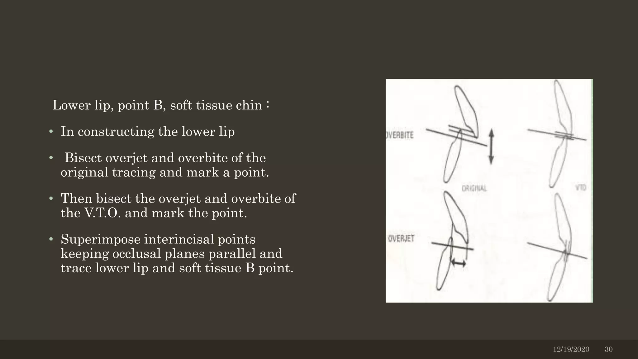 Lower lip, point B, soft tissue chin :
• In constructing the lower lip
• Bisect overjet and overbite of the
original tracing and mark a point.
• Then bisect the overjet and overbite of
the V.T.O. and mark the point.
• Superimpose interincisal points
keeping occlusal planes parallel and
trace lower lip and soft tissue B point.
12/19/2020 30
 