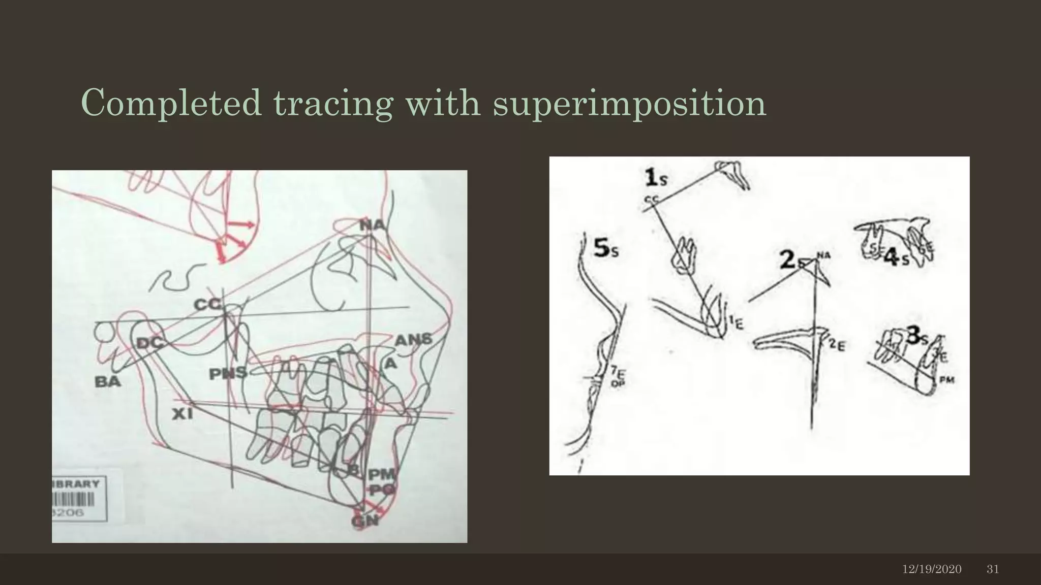 Completed tracing with superimposition
12/19/2020 31
 