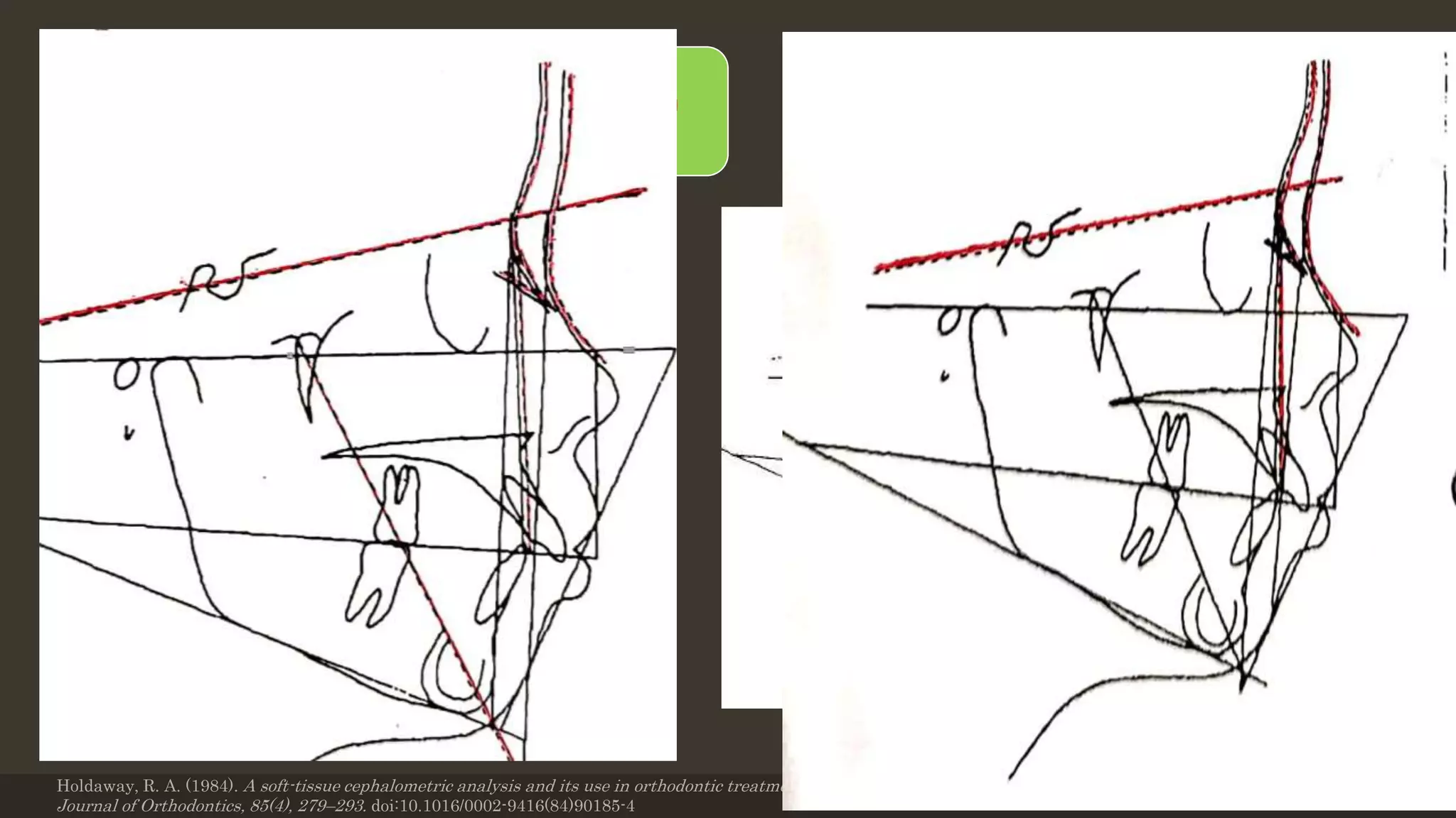 12 sequential steps
Plane of reference is Sn plane
Step 1: Copying original tracing
a) The frontonasal area
b) The sella nasion line
c) The nasion point A line
• Step 2:
A) Superimpose SN line.
B) Move the tracing to show expected
growth. Copy the sella outline.
C) copy or change facial axis.
Holdaway, R. A. (1984). A soft-tissue cephalometric analysis and its use in orthodontic treatment planning. Part II. American
Journal of Orthodontics, 85(4), 279–293. doi:10.1016/0002-9416(84)90185-4
12/19/2020 32
Holdaway’s VTO
 