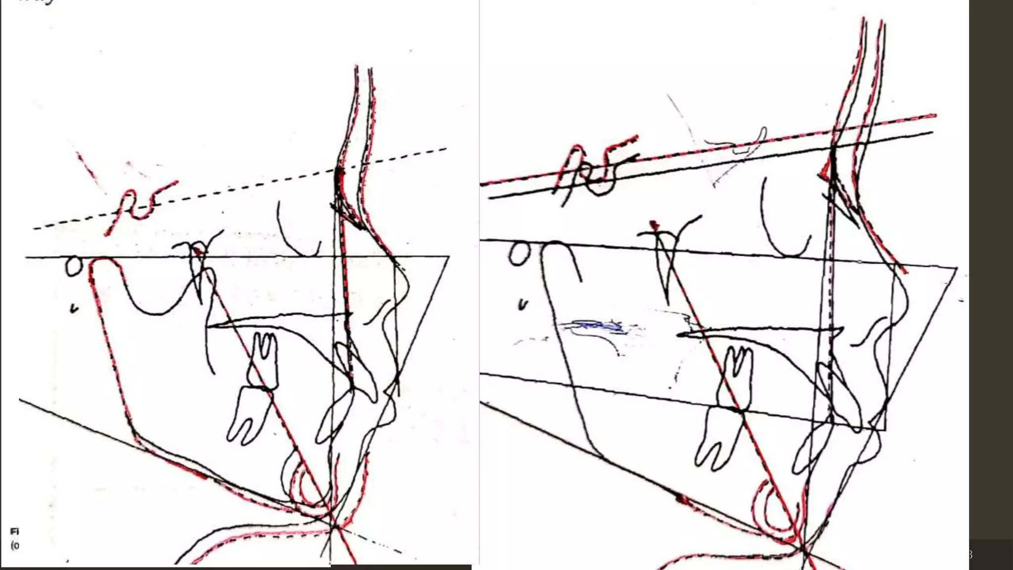 Step 3: Vertical growth of mandible
determining anterior facial height
a) Superimpose VTO tracing on SN
line.Move VTO SN line above
original SN
b) copy the anterior portion of the
mandible, including the symphysis
and anterior half of the lower border.
Also draw the soft-tissue chin
c) Copy the Downs mandibular plane
Step 4 : Anteroposterior growth of
mandible, determining the posterior
border
a) superimpose on the mandibular
plane and move the VT0 forward
until the original sella and the VT0
sella are in a vertical relation.
b) with the tracing in this position, copy
the gonial angle, the posterior
border, and the ramus.
c) superimpose on sella to complete the
condyle.
12/19/2020 33
 
