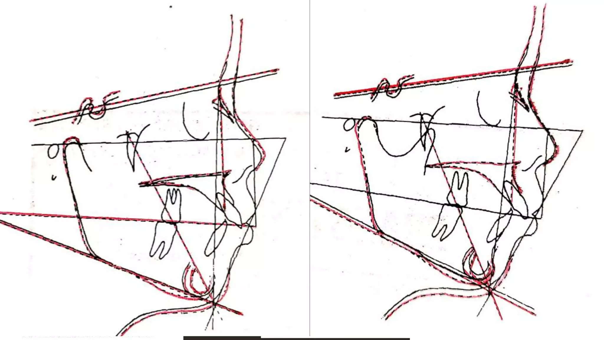 • Step 5: Maxilla and Lower nose
a) Superimpose the VTO NA line on the
original NA line and move the VTO up
until 40% of the total growth is
expressed above the SN line and 60%
below the mandible.
b) With the tracing in this position, copy
the maxilla to include the posterior
two thirds of the hard palate, PNS to
ANS to 3 mm below ANS.
c) with the tracing in this same position,
complete the nose outline around the
tip to the middle of the inferior surface.
• Step 6: Occlusal Plane
a) with the VT0 still superimposed on the
line NA, move the VT0 so that vertical
growth between the maxilla and the
mandible is expressed 50% above the
maxilla and 50% below the mandible.
b) with the tracing in this position, copy
the occlusal plan.
12/19/2020 34
 