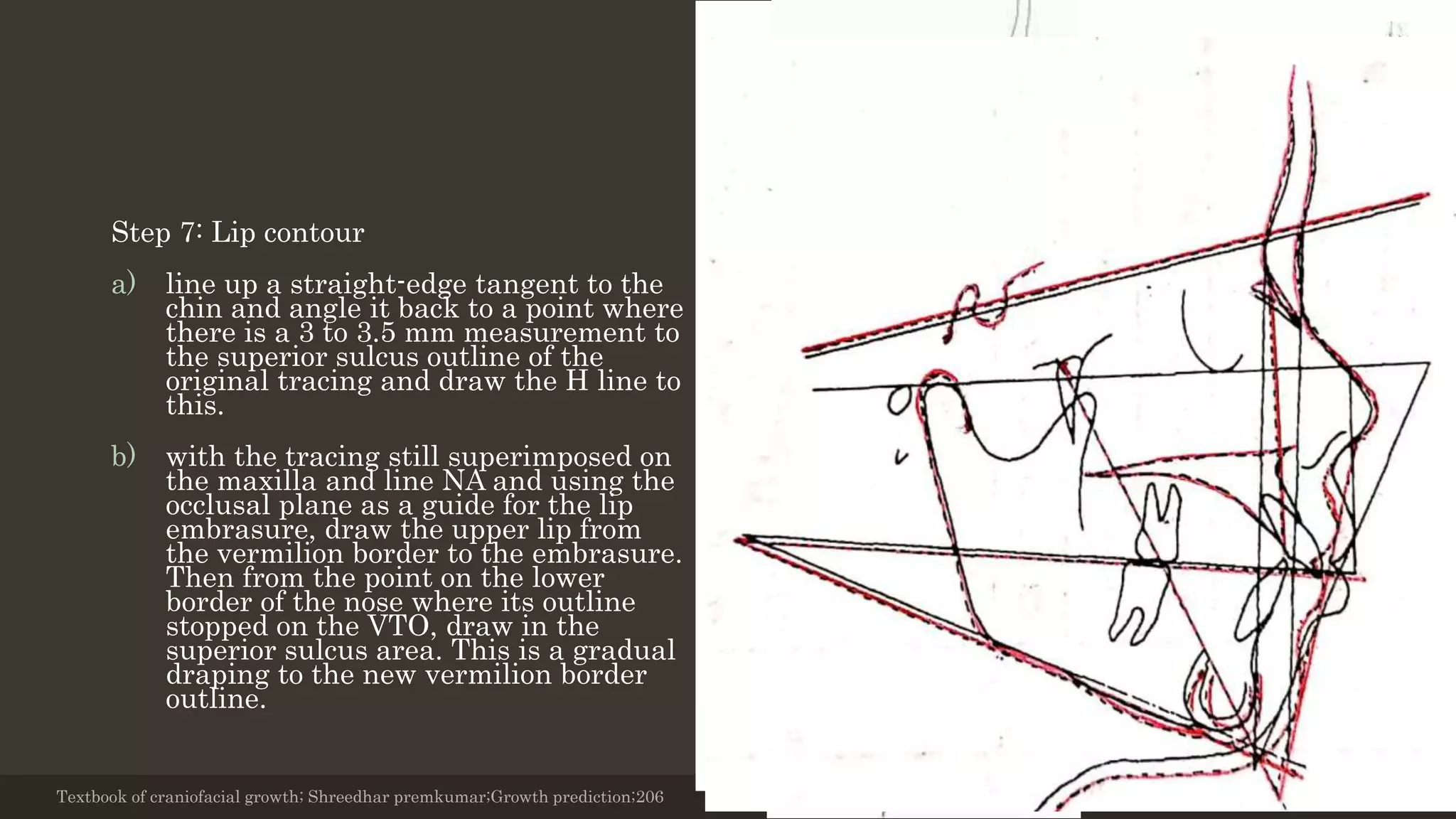 Step 7: Lip contour
a) line up a straight-edge tangent to the
chin and angle it back to a point where
there is a 3 to 3.5 mm measurement to
the superior sulcus outline of the
original tracing and draw the H line to
this.
b) with the tracing still superimposed on
the maxilla and line NA and using the
occlusal plane as a guide for the lip
embrasure, draw the upper lip from
the vermilion border to the embrasure.
Then from the point on the lower
border of the nose where its outline
stopped on the VTO, draw in the
superior sulcus area. This is a gradual
draping to the new vermilion border
outline.
Textbook of craniofacial growth; Shreedhar premkumar;Growth prediction;206 12/19/2020 35
 