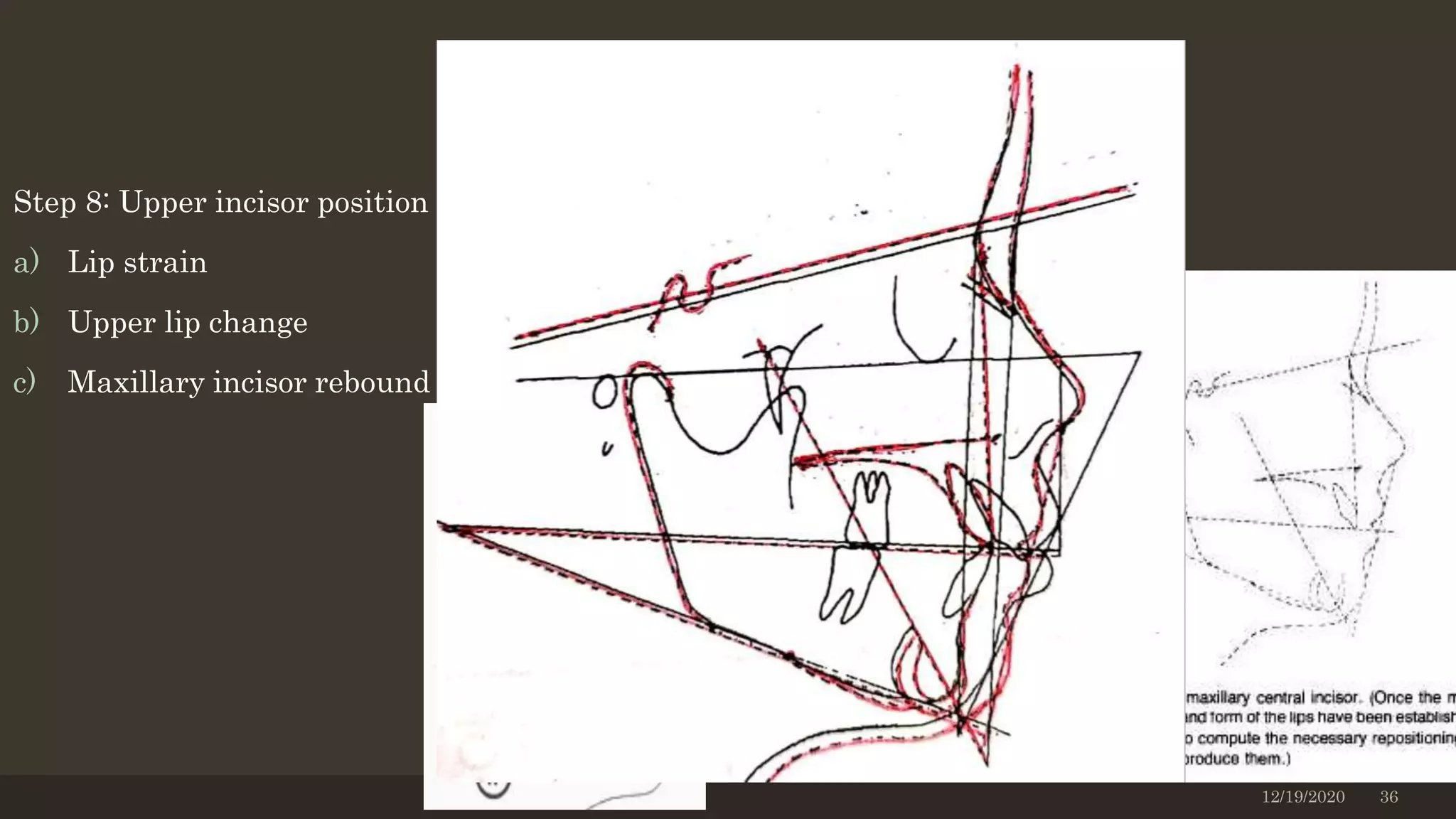 Step 8: Upper incisor position
a) Lip strain
b) Upper lip change
c) Maxillary incisor rebound
12/19/2020 36
 