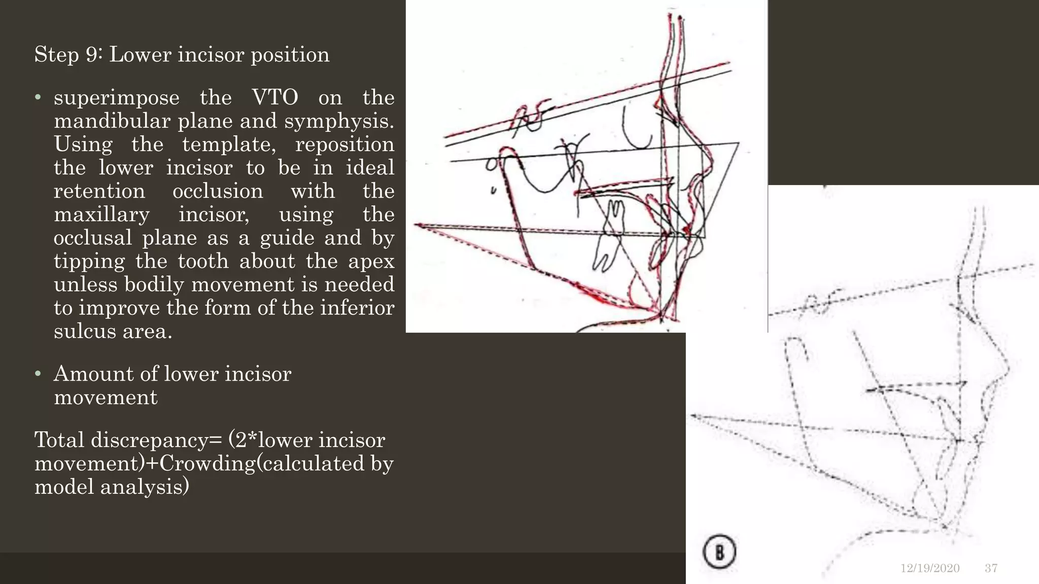 Step 9: Lower incisor position
• superimpose the VTO on the
mandibular plane and symphysis.
Using the template, reposition
the lower incisor to be in ideal
retention occlusion with the
maxillary incisor, using the
occlusal plane as a guide and by
tipping the tooth about the apex
unless bodily movement is needed
to improve the form of the inferior
sulcus area.
• Amount of lower incisor
movement
Total discrepancy= (2*lower incisor
movement)+Crowding(calculated by
model analysis)
12/19/2020 37
 