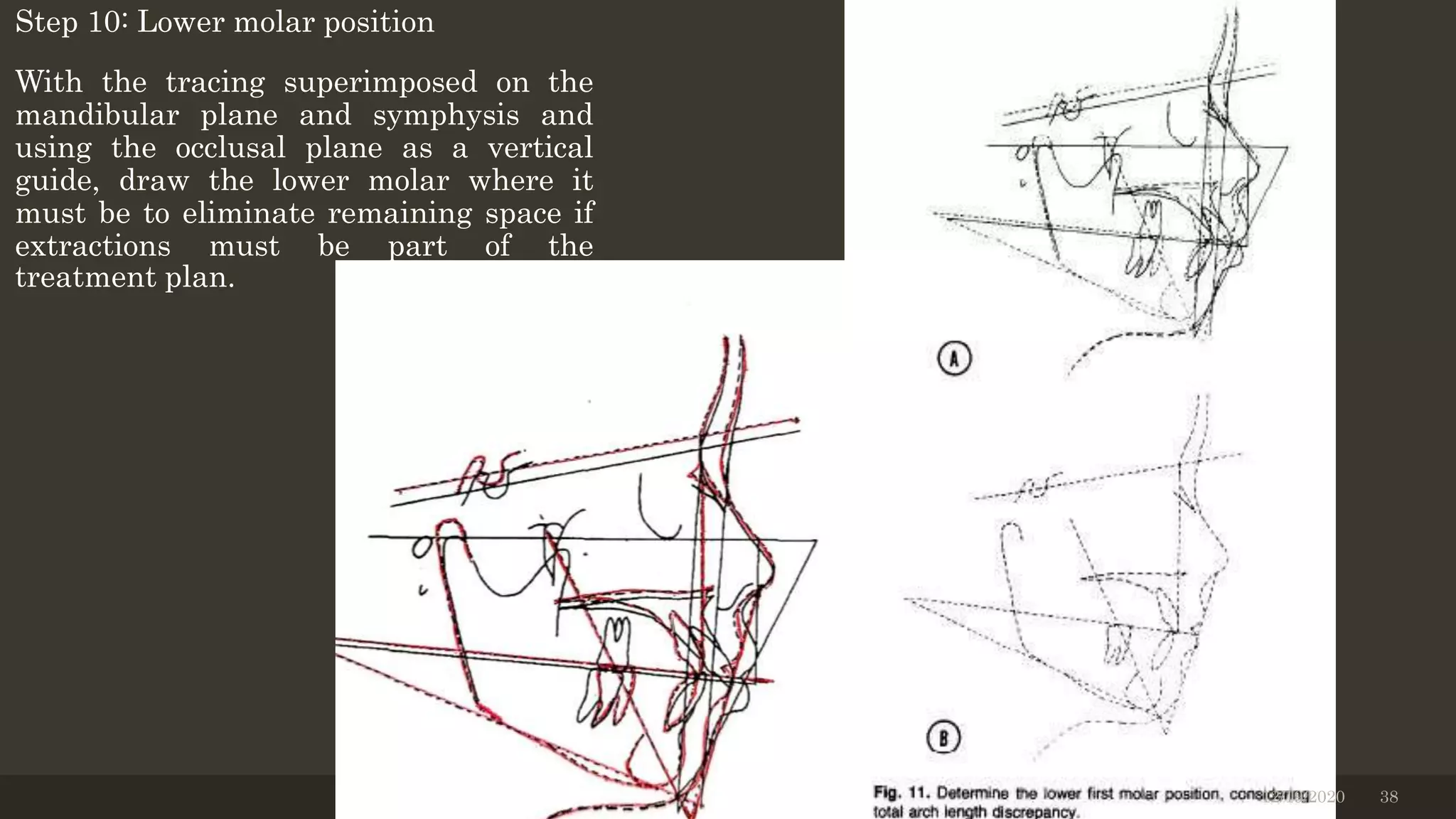 Step 10: Lower molar position
With the tracing superimposed on the
mandibular plane and symphysis and
using the occlusal plane as a vertical
guide, draw the lower molar where it
must be to eliminate remaining space if
extractions must be part of the
treatment plan.
12/19/2020 38
 