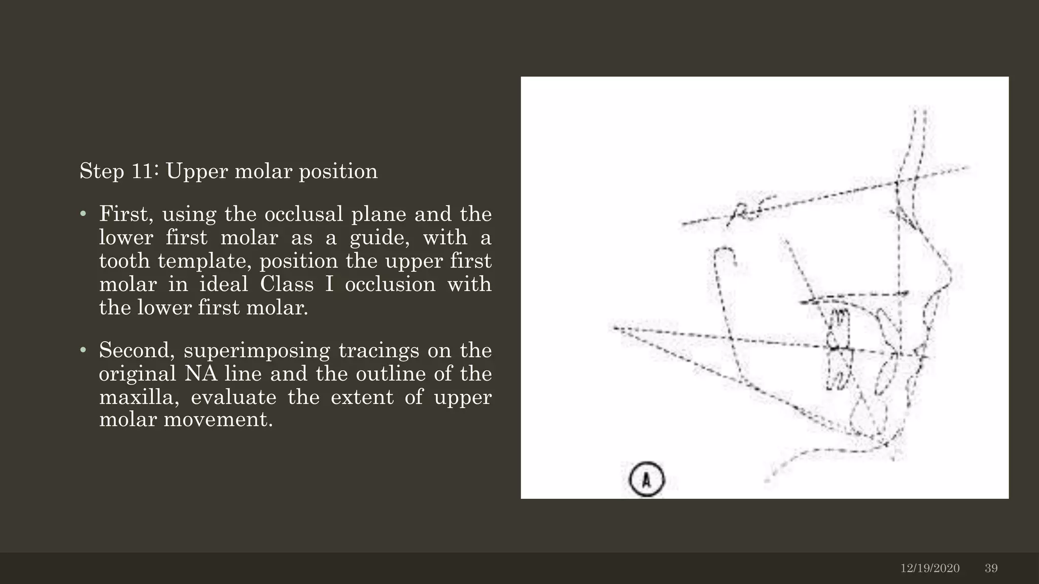 Step 11: Upper molar position
• First, using the occlusal plane and the
lower first molar as a guide, with a
tooth template, position the upper first
molar in ideal Class I occlusion with
the lower first molar.
• Second, superimposing tracings on the
original NA line and the outline of the
maxilla, evaluate the extent of upper
molar movement.
12/19/2020 39
 