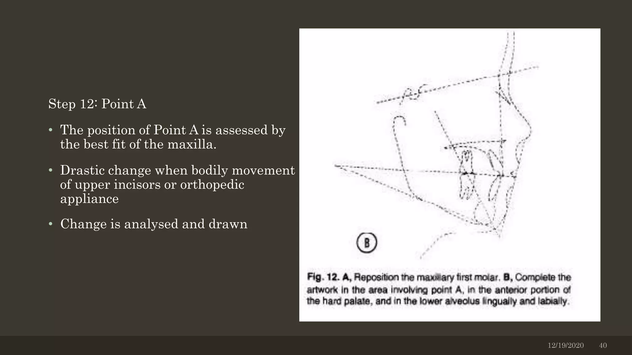 Step 12: Point A
• The position of Point A is assessed by
the best fit of the maxilla.
• Drastic change when bodily movement
of upper incisors or orthopedic
appliance
• Change is analysed and drawn
12/19/2020 40
 