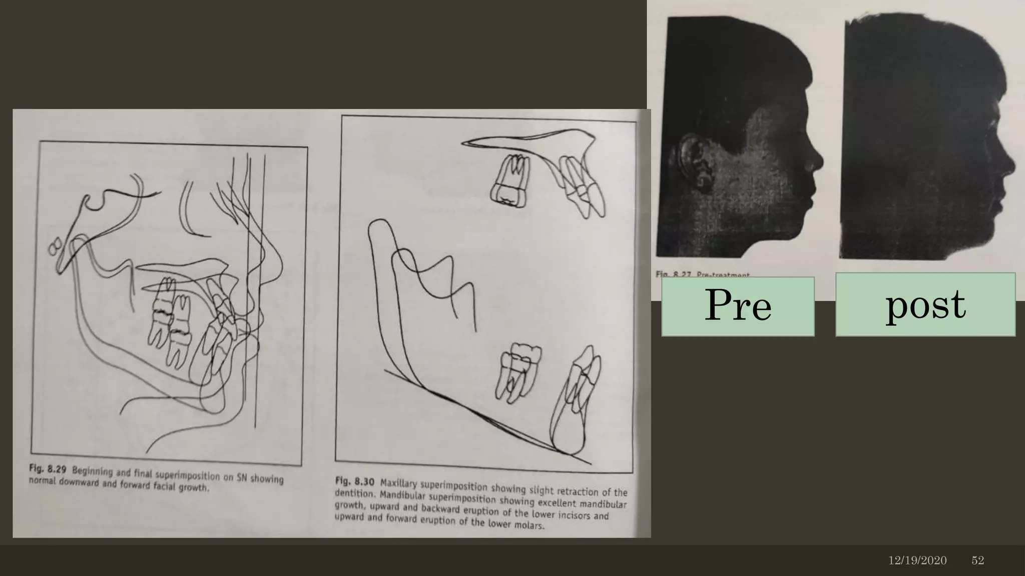 12/19/2020 52
Pre post
 