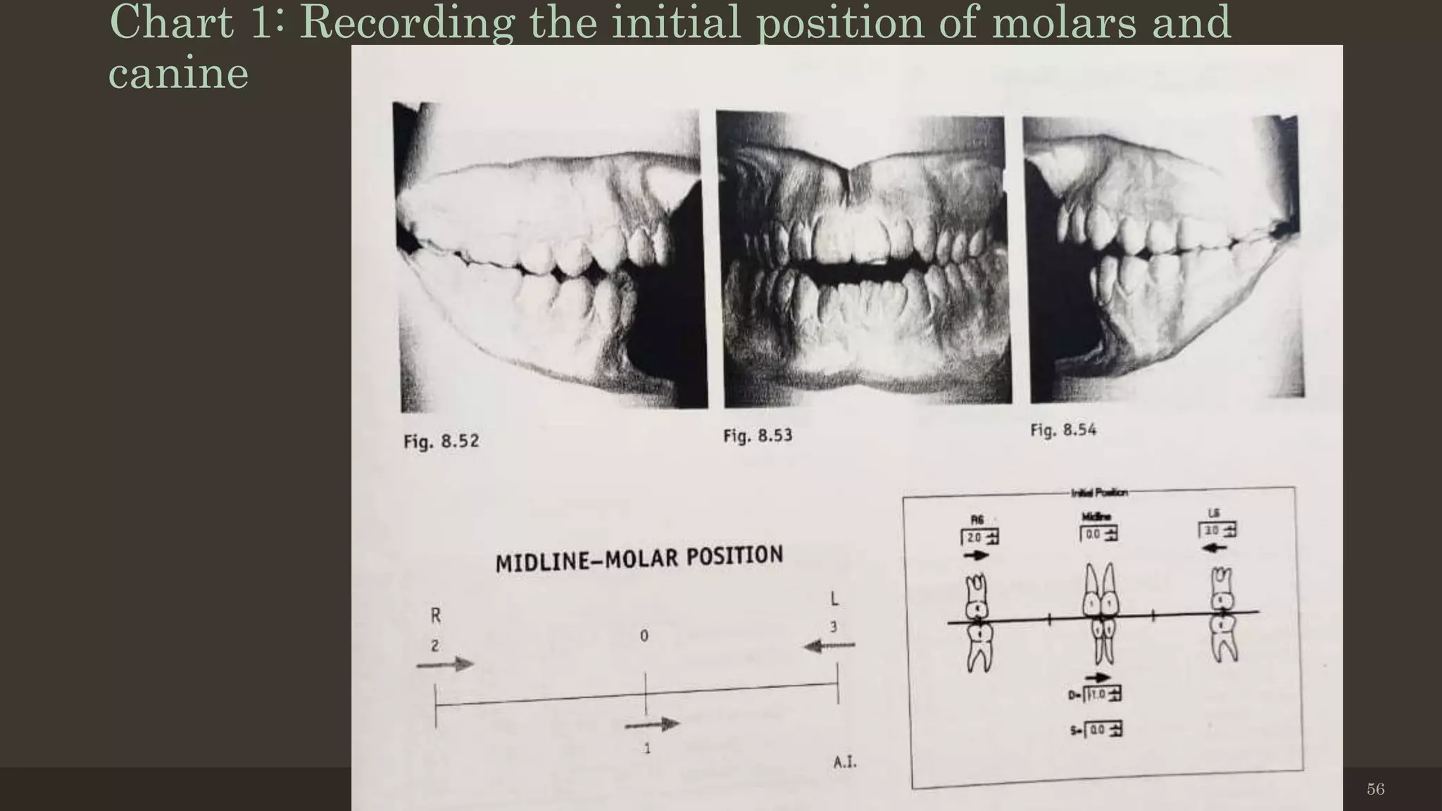 Chart 1: Recording the initial position of molars and
canine
12/19/2020 56
 
