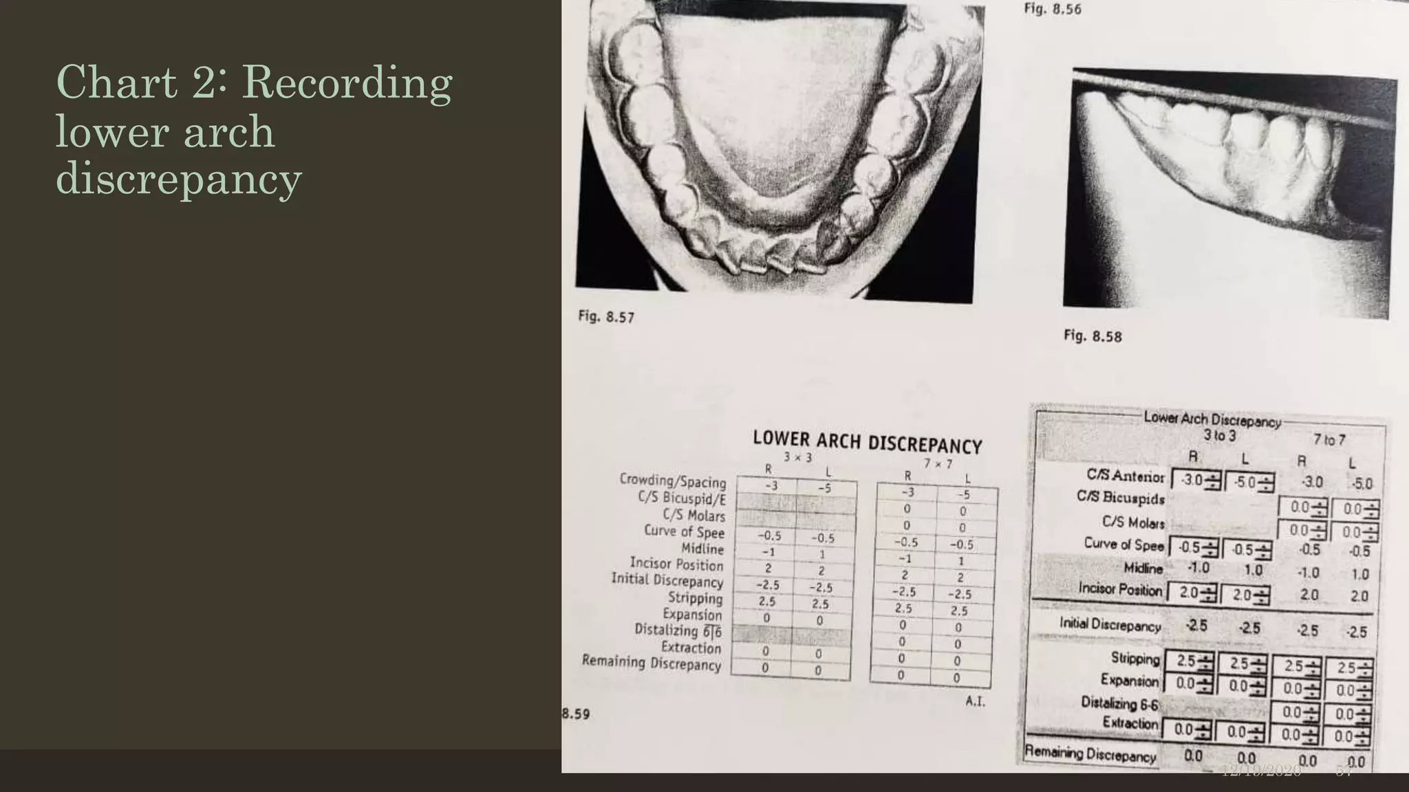Chart 2: Recording
lower arch
discrepancy
12/19/2020 57
 