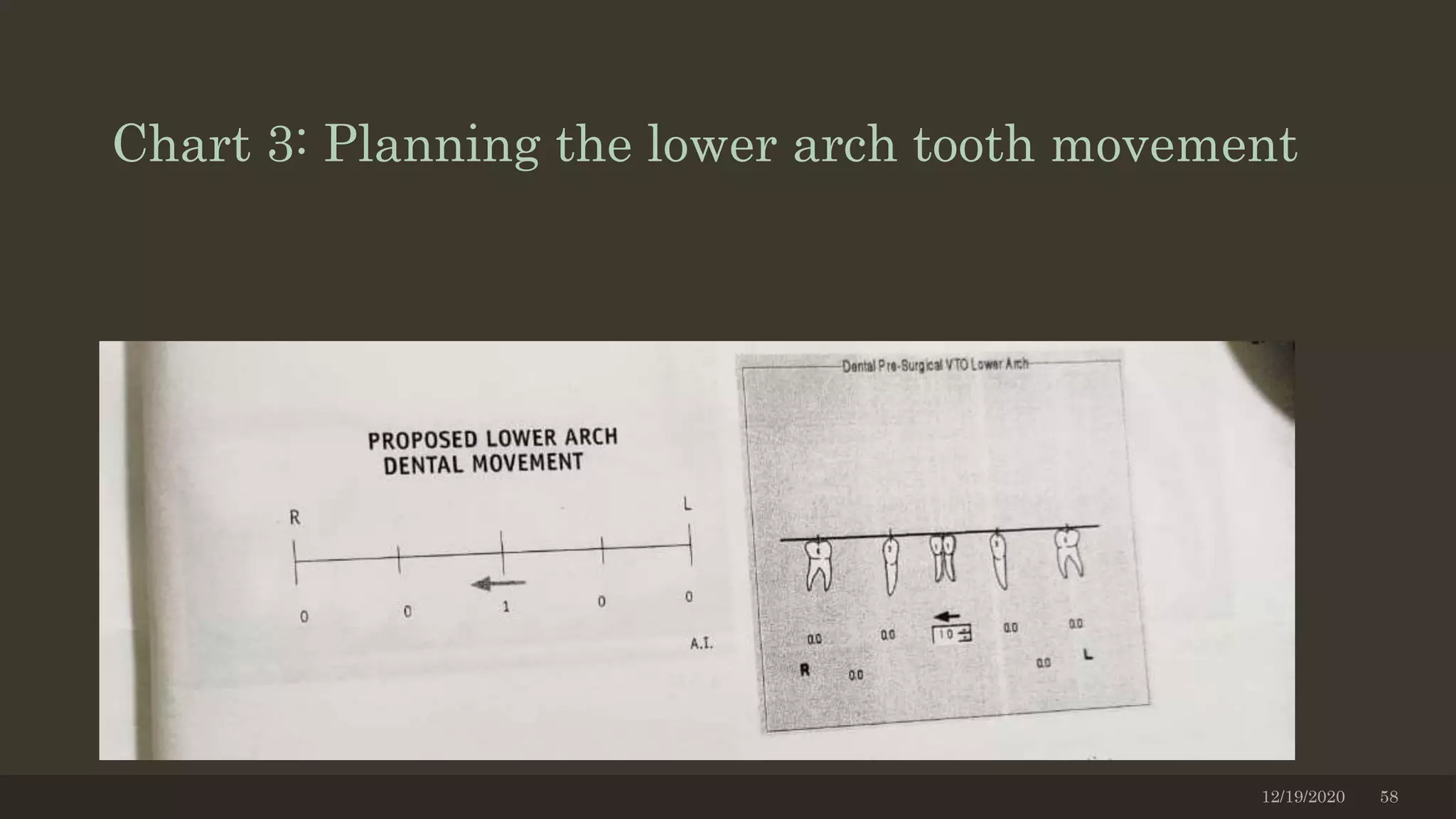 Chart 3: Planning the lower arch tooth movement
12/19/2020 58
 