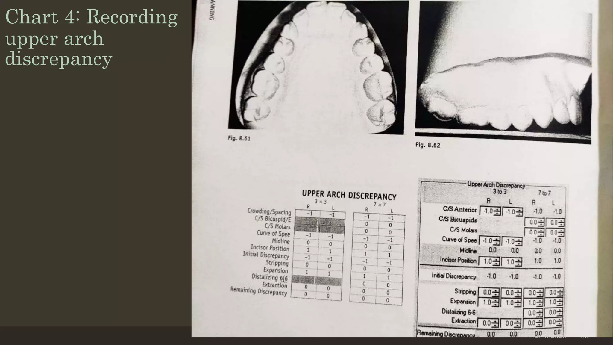 Chart 4: Recording
upper arch
discrepancy
12/19/2020 59
 