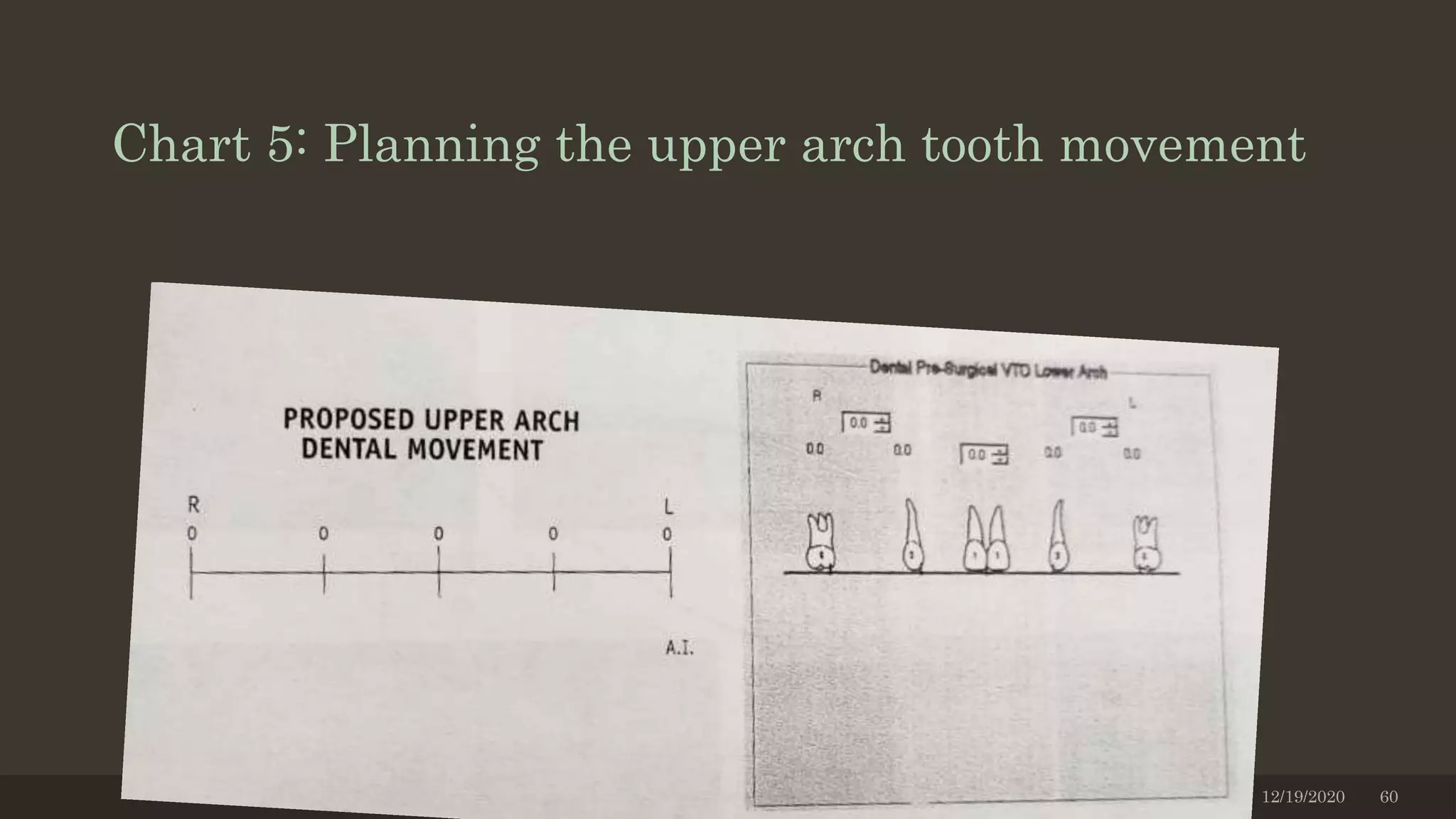 Chart 5: Planning the upper arch tooth movement
12/19/2020 60
 