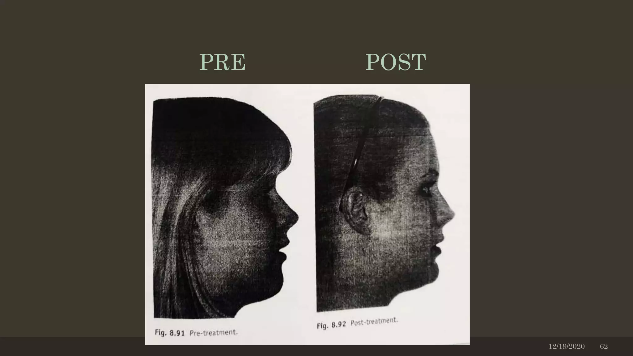 12/19/2020 62
PRE POST
 