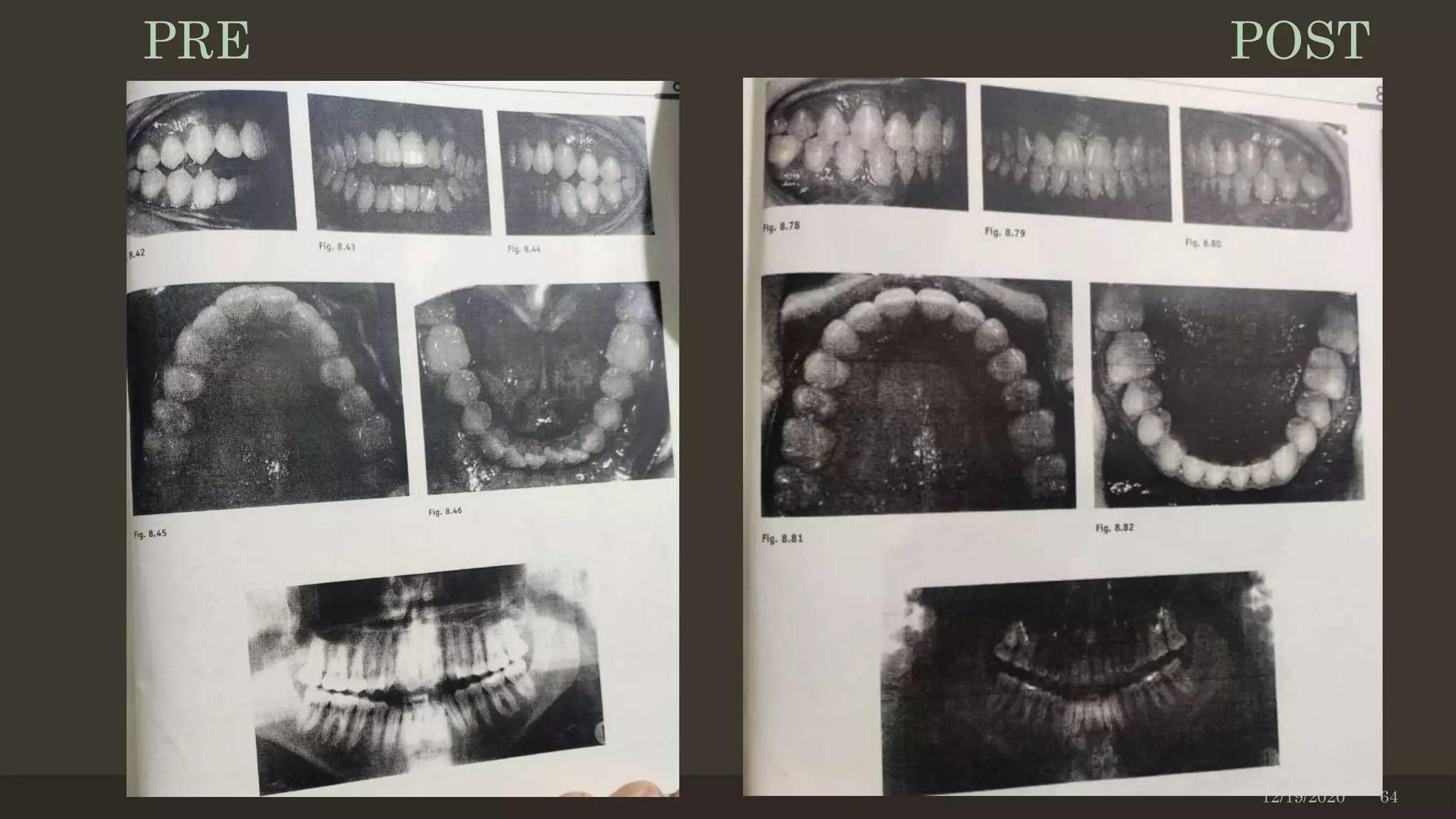 12/19/2020 64
PRE POST
 