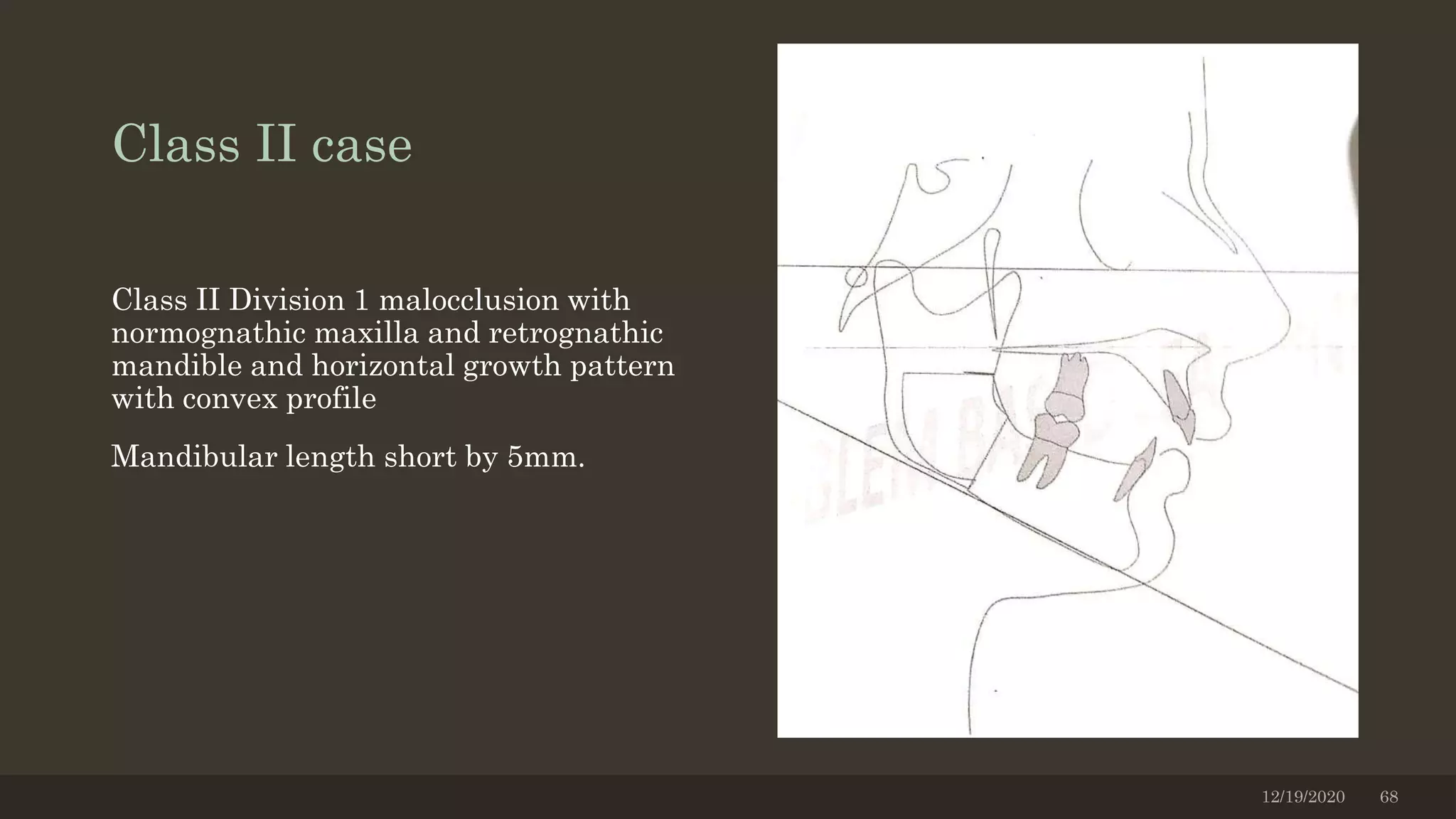 Class II case
Class II Division 1 malocclusion with
normognathic maxilla and retrognathic
mandible and horizontal growth pattern
with convex profile
Mandibular length short by 5mm.
12/19/2020 68
 