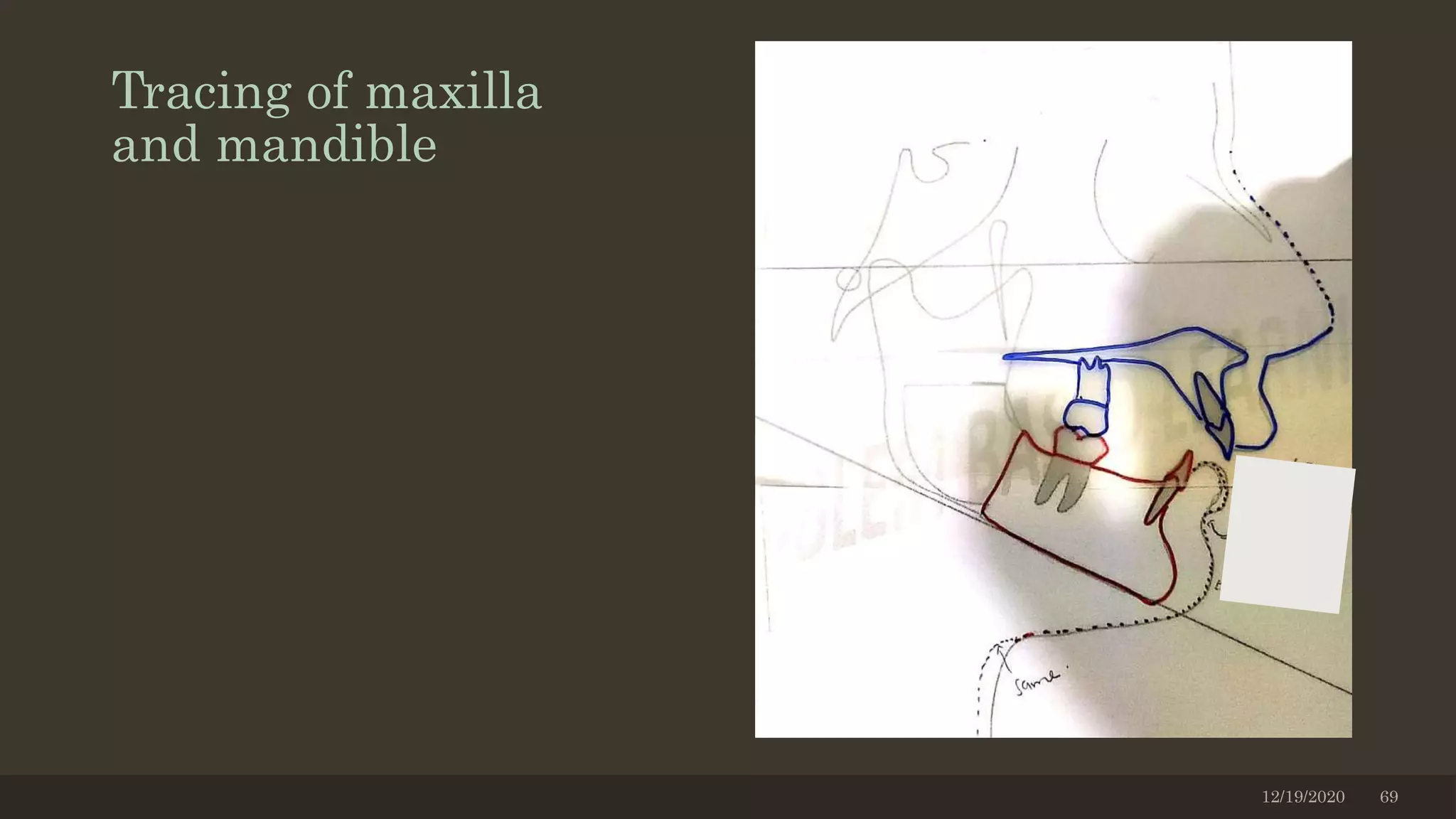 Tracing of maxilla
and mandible
12/19/2020 69
 