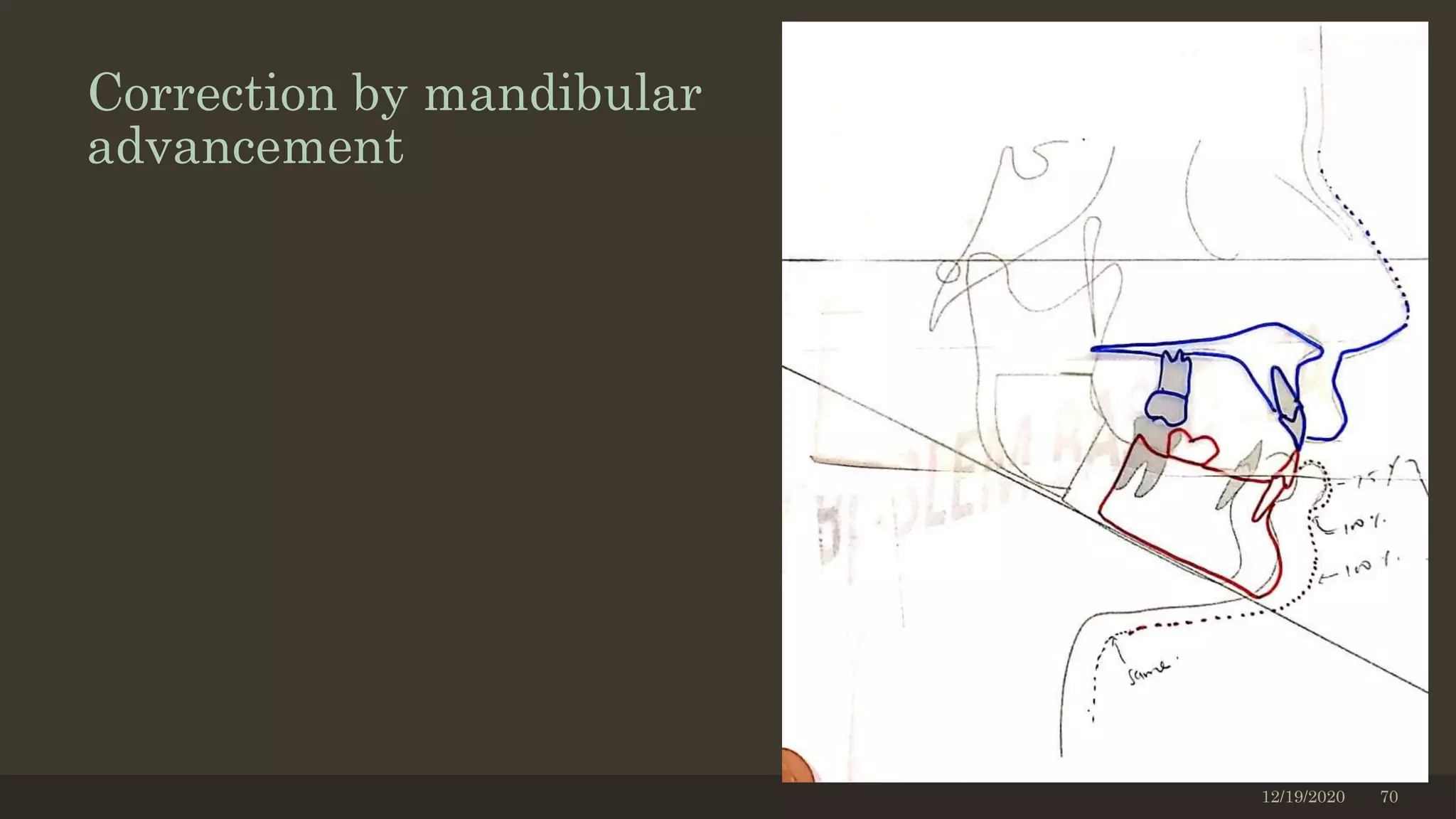 Correction by mandibular
advancement
12/19/2020 70
 