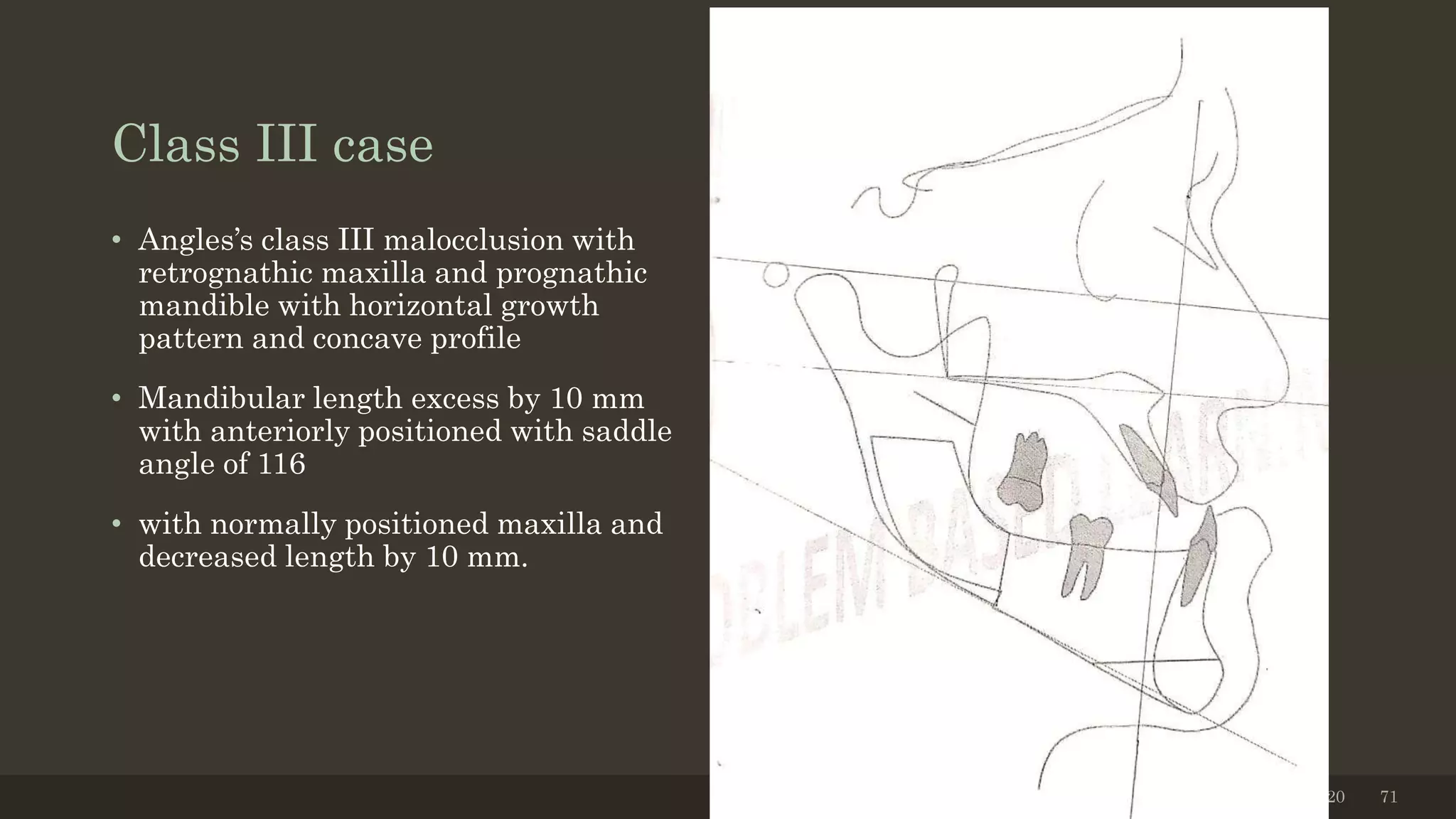 Class III case
• Angles’s class III malocclusion with
retrognathic maxilla and prognathic
mandible with horizontal growth
pattern and concave profile
• Mandibular length excess by 10 mm
with anteriorly positioned with saddle
angle of 116
• with normally positioned maxilla and
decreased length by 10 mm.
12/19/2020 71
 