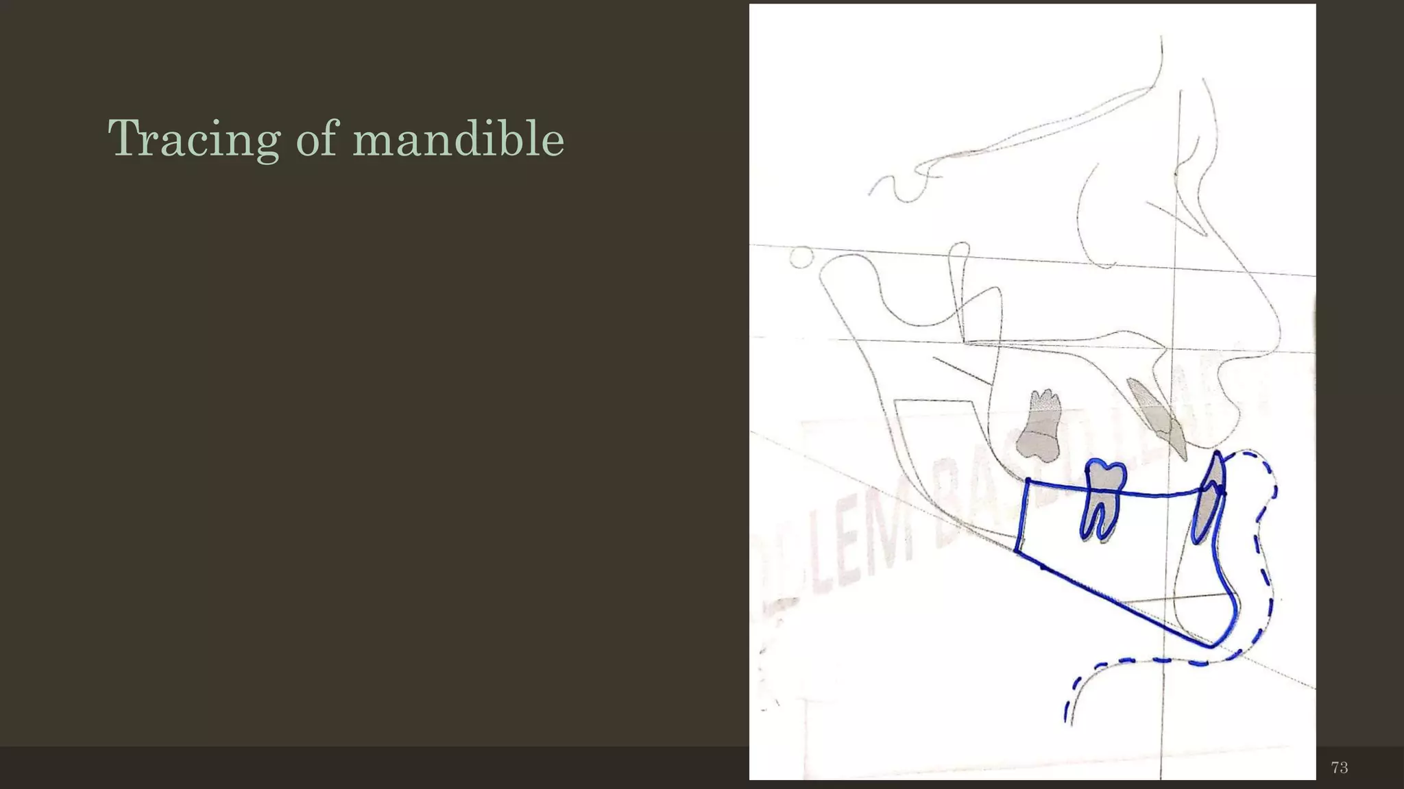 Tracing of mandible
12/19/2020 73
 