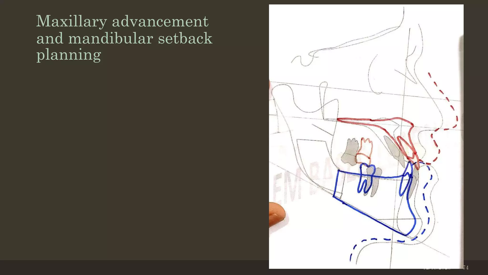 Maxillary advancement
and mandibular setback
planning
12/19/2020 74
 